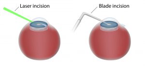 laser-vs-blade-cataract